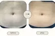 Experience CoolSculpting for body or chin paired with laser skin tightening at Enigma Medi Spa & Laser Center, offering up to 25% off - Second Medium