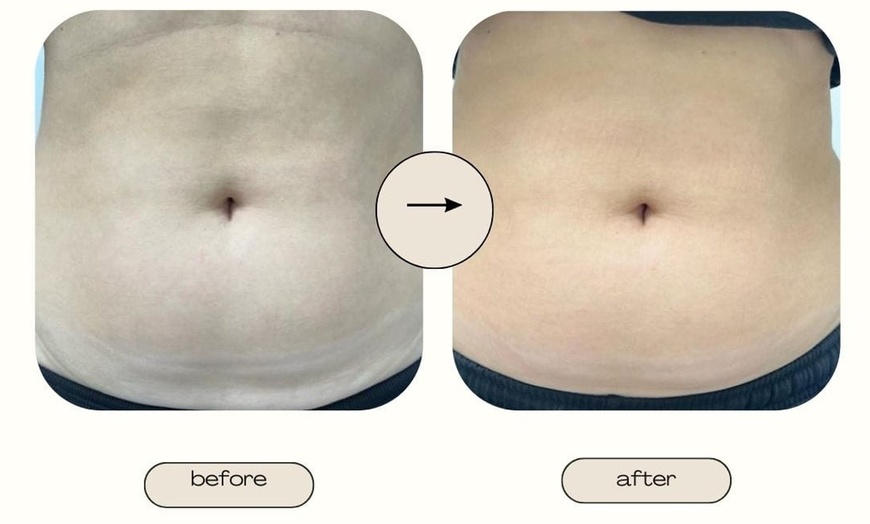 Image 2: CoolSculpting for Body or Chin with Laser Skin Tightening