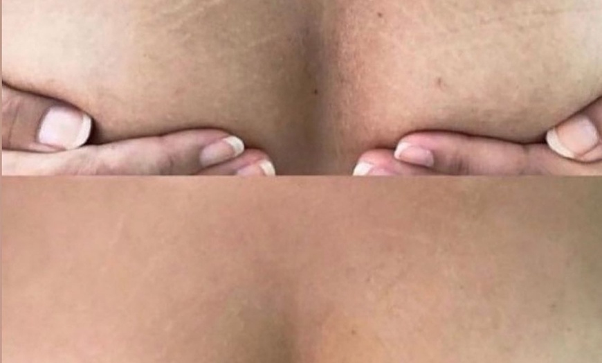 Image 2: Traitement des vergetures STRIORT d'une heure
