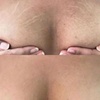 Image 2: Traitement des vergetures STRIORT d'une heure