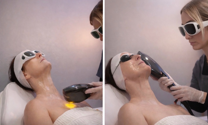 Image 2: Rejuvenate Your Skin with One or Three Photofacial IPL Treatment