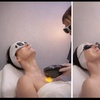 Image 2: Rejuvenate Your Skin with One or Three Photofacial IPL Treatment