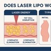 Image 2: Laser Lipo Sessions with Whole-Body Vibration Available Now