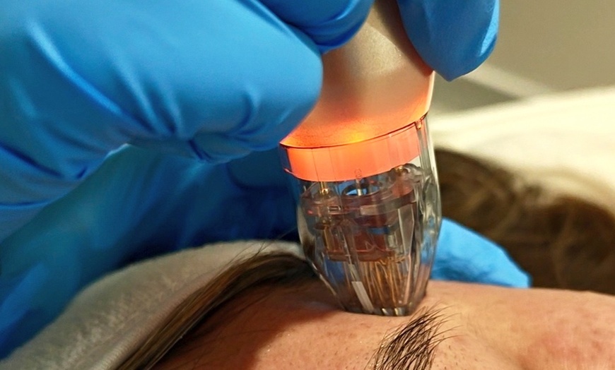 Image 7: Reverse Ageing & Repair Scars: Sylfirm X (One, Two, or Three Sessions)