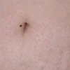 Image 1: Inkless Paramedical Tattoo for Stretch Marks and Scars