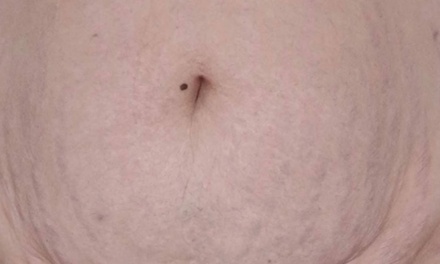Stretchmark Inkless – Paramedical Tattoo Technique - Stretch Mark Treatment by Nina