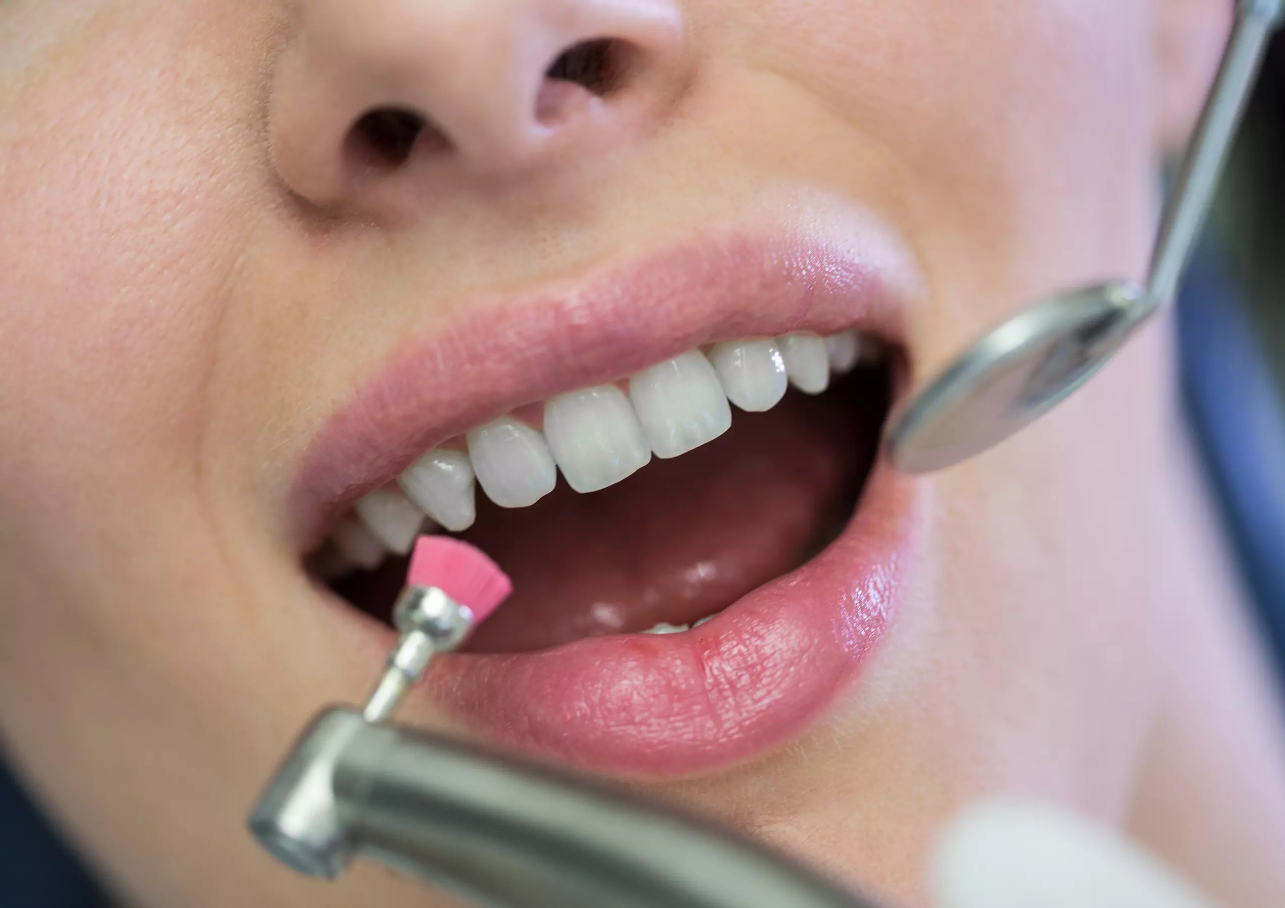 In-Office Crown Whitening Treatment with Consultation and Optional Whitening Kit at Green Dental (Up to 52% Off)