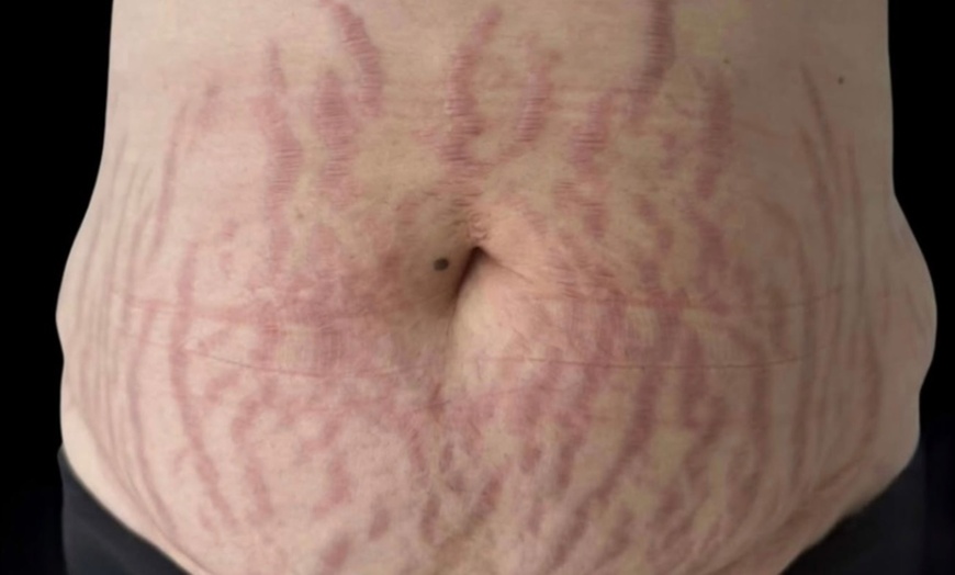 Image 2: Inkless Paramedical Tattoo for Stretch Marks and Scars