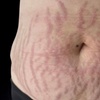 Image 2: Inkless Paramedical Tattoo for Stretch Marks and Scars