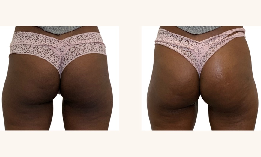 Image 4: Up to 47% Off on Non-Surgical Butt Lift