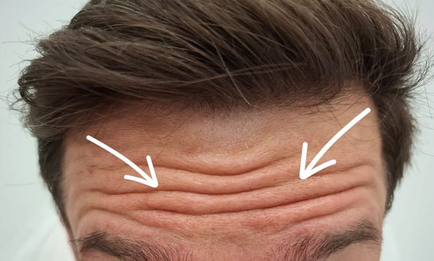 Image 6: Do 56% zniżki na Zastrzyk - Botox w Richter Clinic Iwona Richter