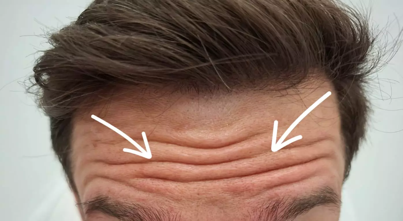 Do 56% zniżki na Zastrzyk - Botox w Richter Clinic Iwona Richter