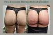 Vacuum Therapy Buttocks and Body Enhancement or CryoStatic Slimming with Vacuum Therapy Combo ( Up to 50% Off ) - Second Medium