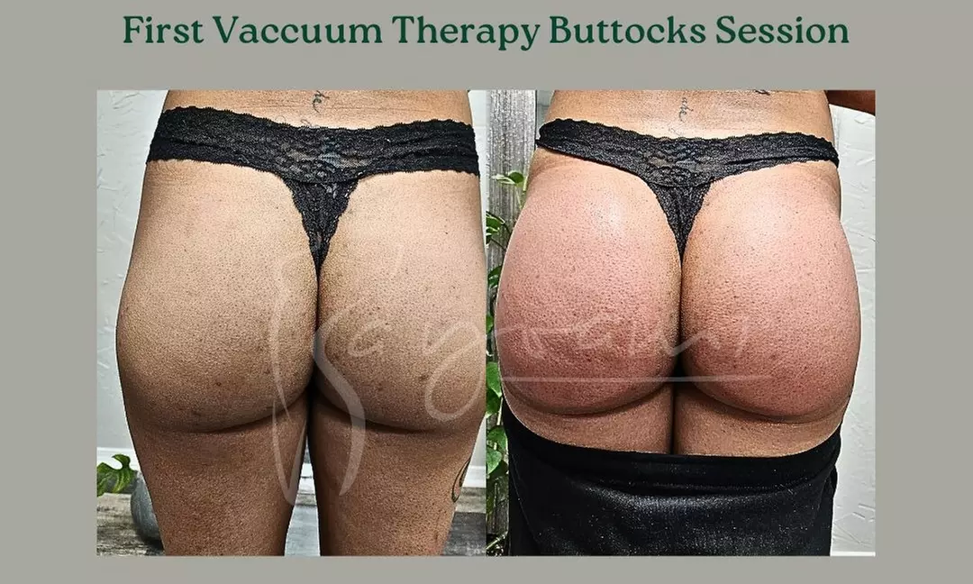Vacuum Therapy Buttocks & Body Enhancement or CryoStatic Slimming