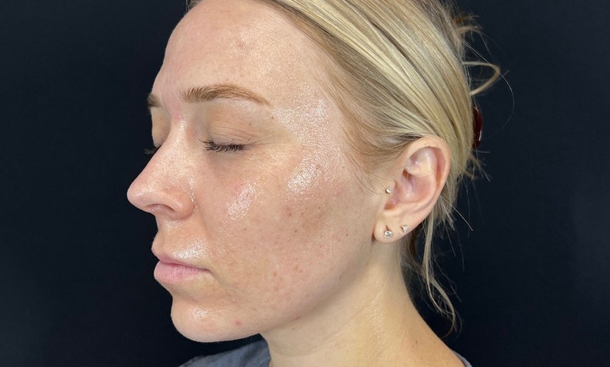 Image 1: Unleash Radiance:Transform Your Skin w/1 or 3 Laser Resurfacing Magic!