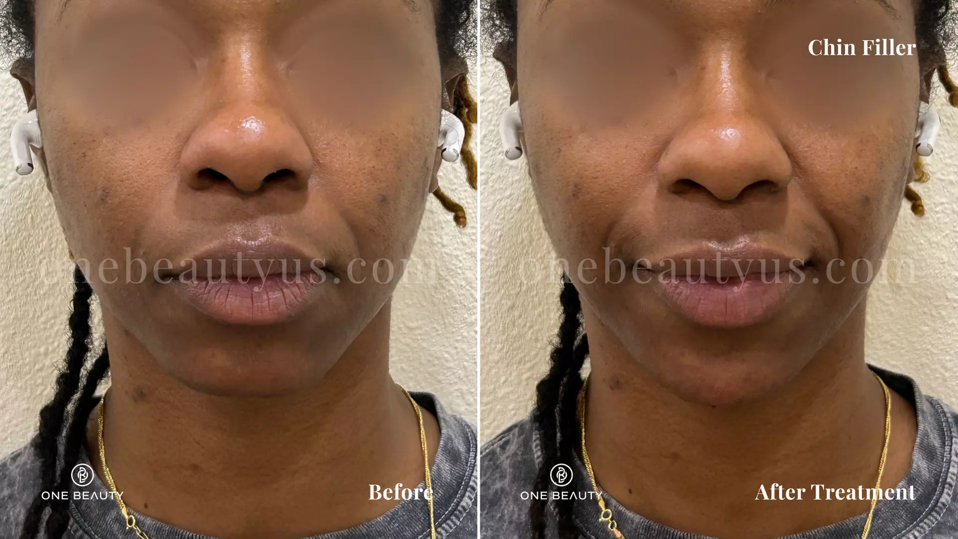 Up to 40% Off on Injection - Restylane at One Beauty Aesthetics - Primary Image