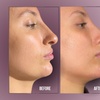 Image 10: Up to 38% Off on Injection - Dermal Filler at Divine Aesthetics Clinic London