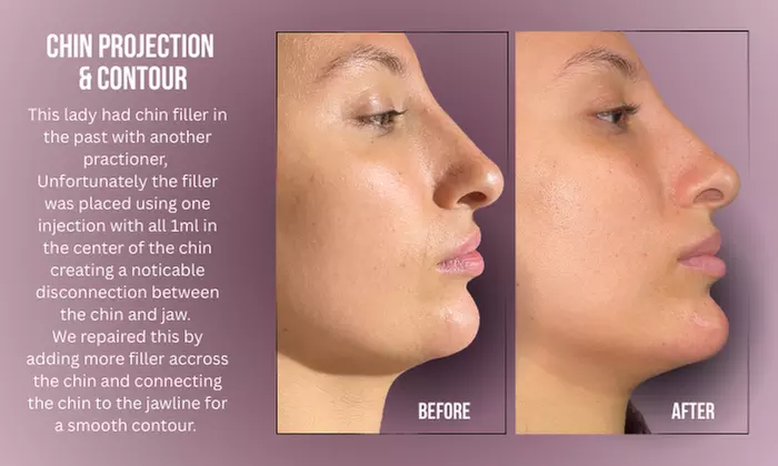 Up to 38% Off on Injection - Dermal Filler at Divine Aesthetics Clinic London