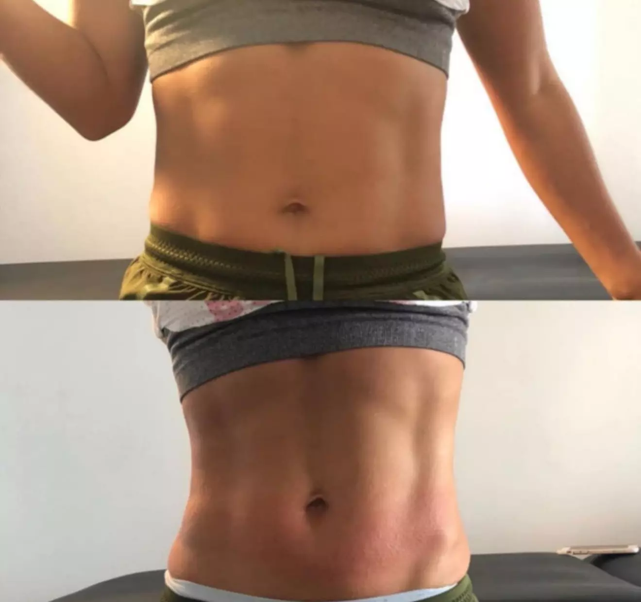 Non-Surgical Solution: Fix Stubborn Fat with Lipo Sculpt Lite