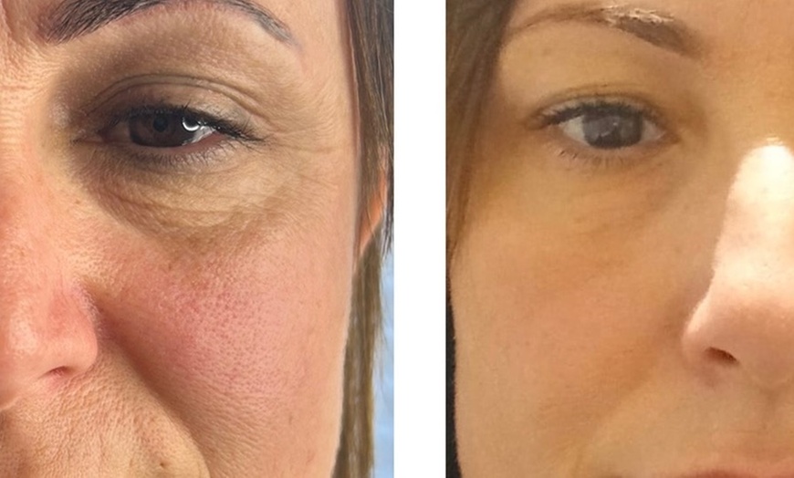 Image 1: Reveal Fresh Skin with 2 Peeling Treatments: Mandelic & TCA Acid