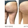 Image 3: Body-Tite – Non-Invasive Cellulite Reduction & Skin Tightening in DC
