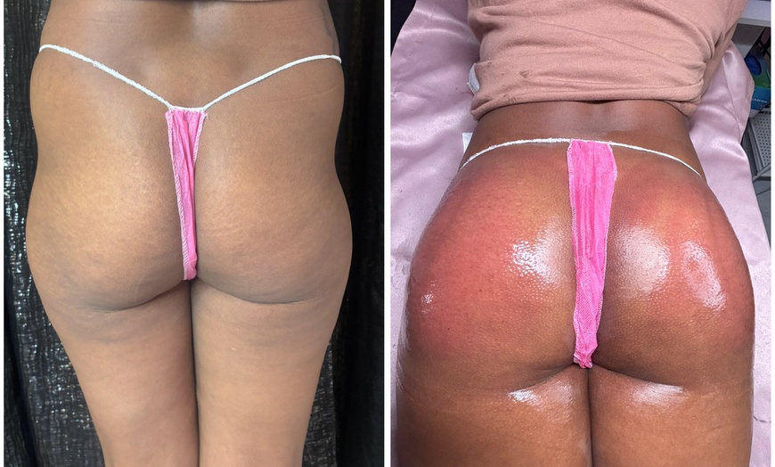 Image 5: Lift and tone with nonsurgical butt cupping sessions