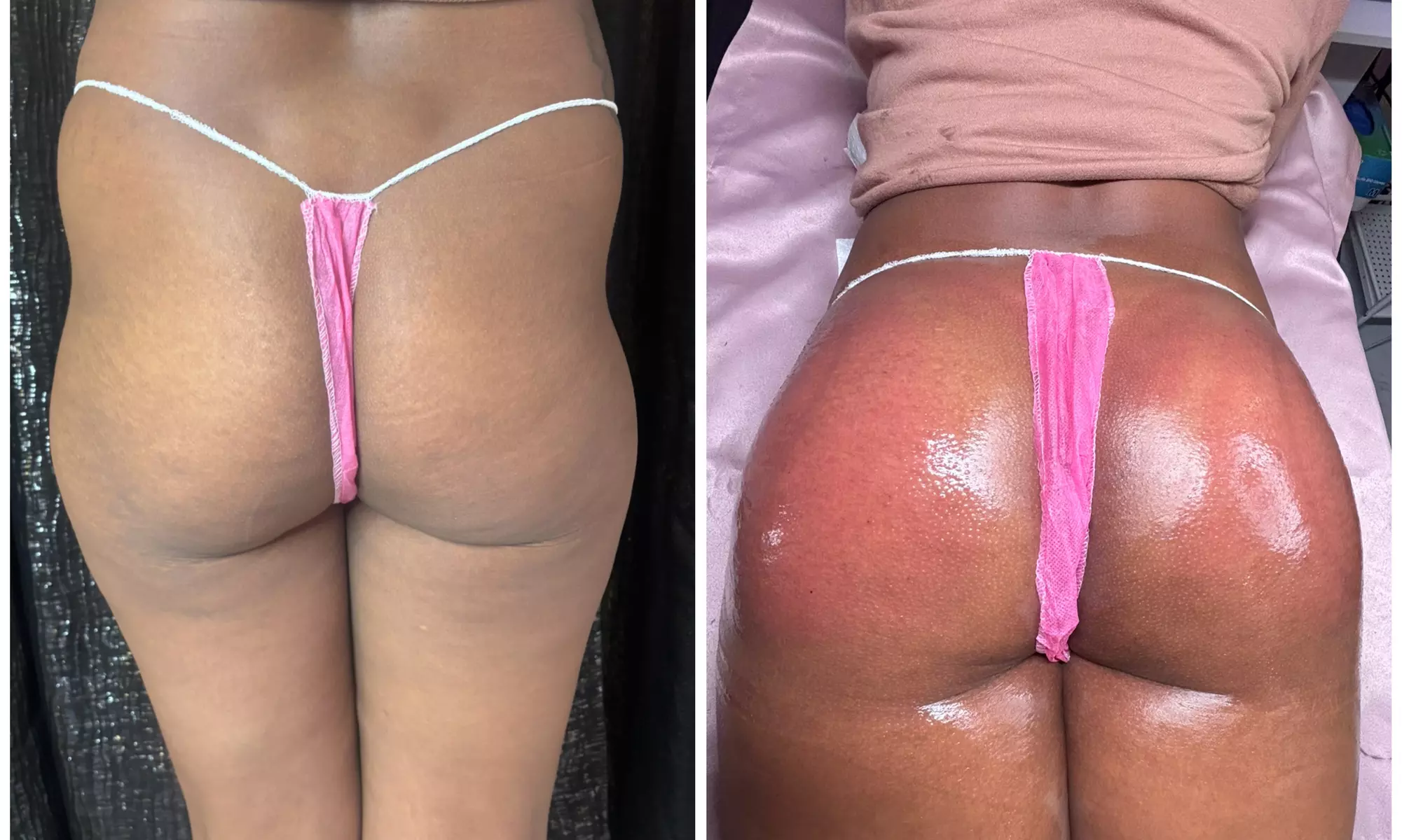 Lift and tone with nonsurgical butt cupping sessions