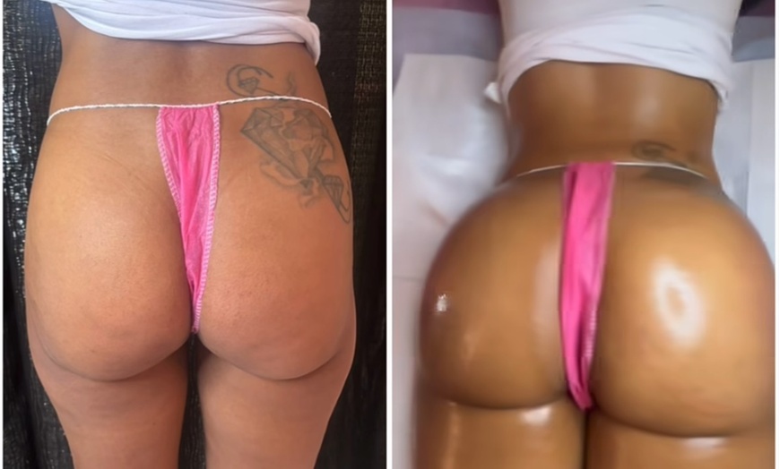 Image 6: Lift and tone with nonsurgical butt cupping sessions