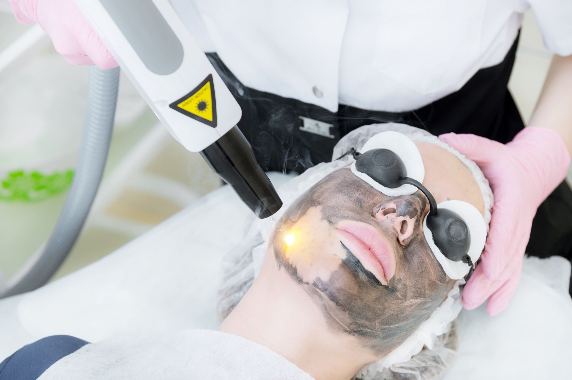 Revitalize Your Skin with Carbon Laser Peel Options
