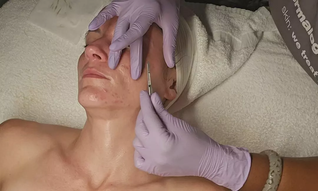 One, Three or Five 60-Min Customized or Dermaplane Facials