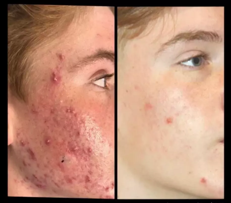 Permanent Acne Reduction with Blue Light Therapy: 1, 2 or 3 Treatments at Contours (Up to 50% Off) - Primary Image