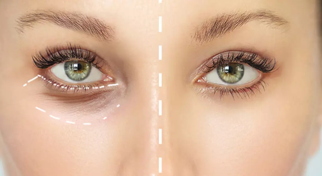 Rajeunir le contour des yeux pour réduire cernes, rides et poches (jusqu'à 54% de remise) - Primary Image