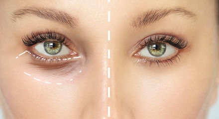 Soin Mesolift contour des yeux, sans aiguilles - Institut Danielle Lanstère