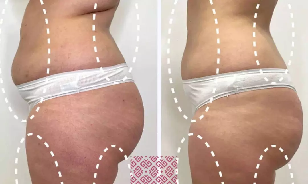 Kompleksowy zabieg modelujący ciało: EndoRF, próżnia i kawitacja