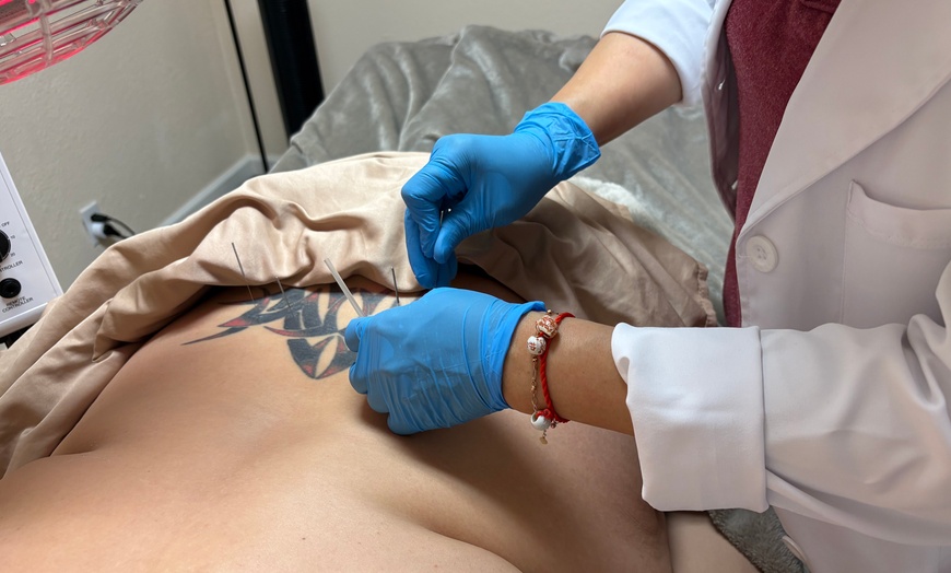 Image 1: Experience 60-min Rejuvenating Acupuncture Sessions with Consultation