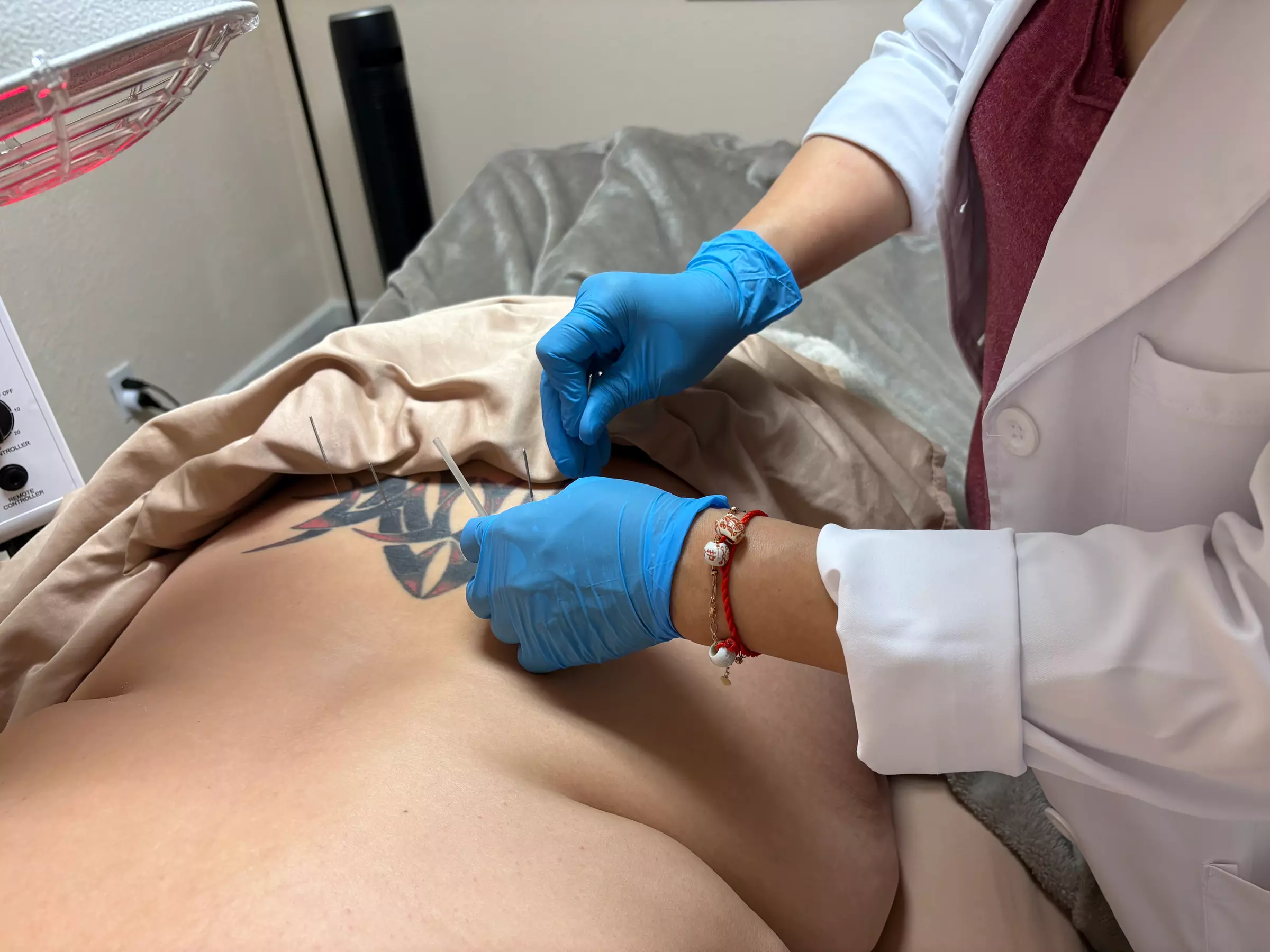 Experience 60-min Rejuvenating Acupuncture Sessions with Consultation
