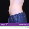 Image 6: Experience Non-Invasive Fat Reduction with TruSculpt