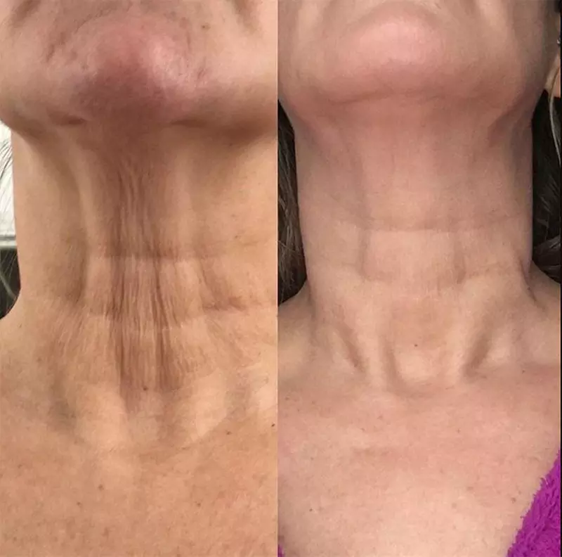 Plasma-Pen Skin-Tightening Session at Body Lab. (Up to 18% Off). Four Options Available. - Second Medium