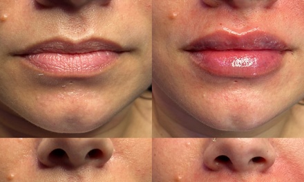 Neck & Jowl Skintightening - SculptMe Studio