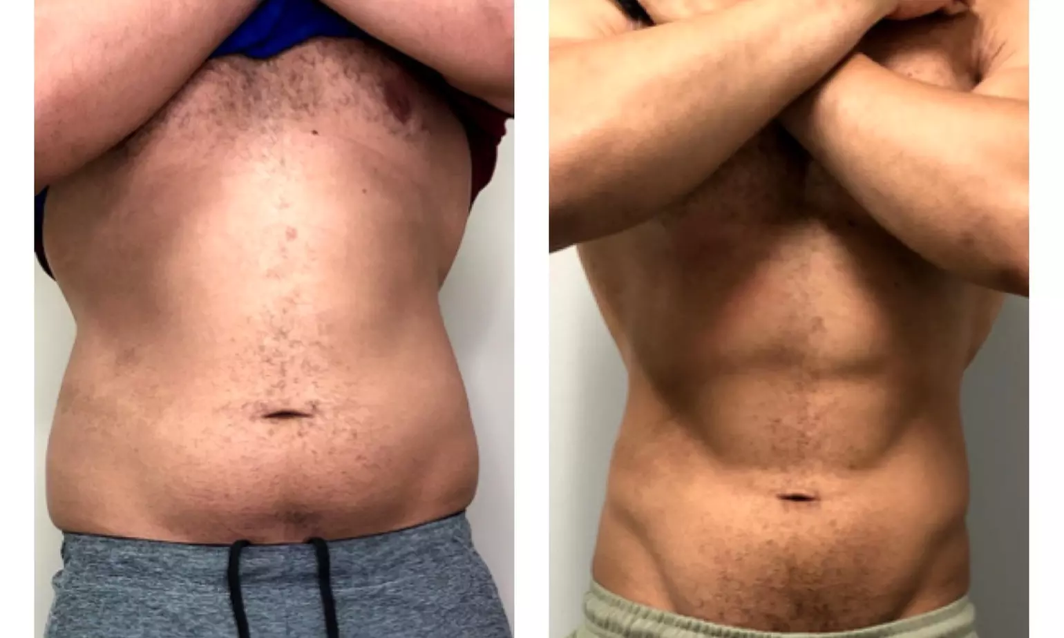 Up to 47% Off on Body Sculpting (Cryolipolysis)