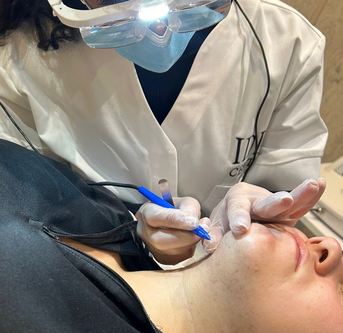 Électrolyse visage : épilation électrique définitive à l'IDL Center