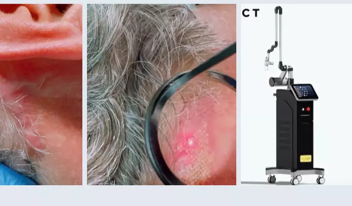 Up to 47% Off on Laser Skin Resurfacing at Hang's Spa