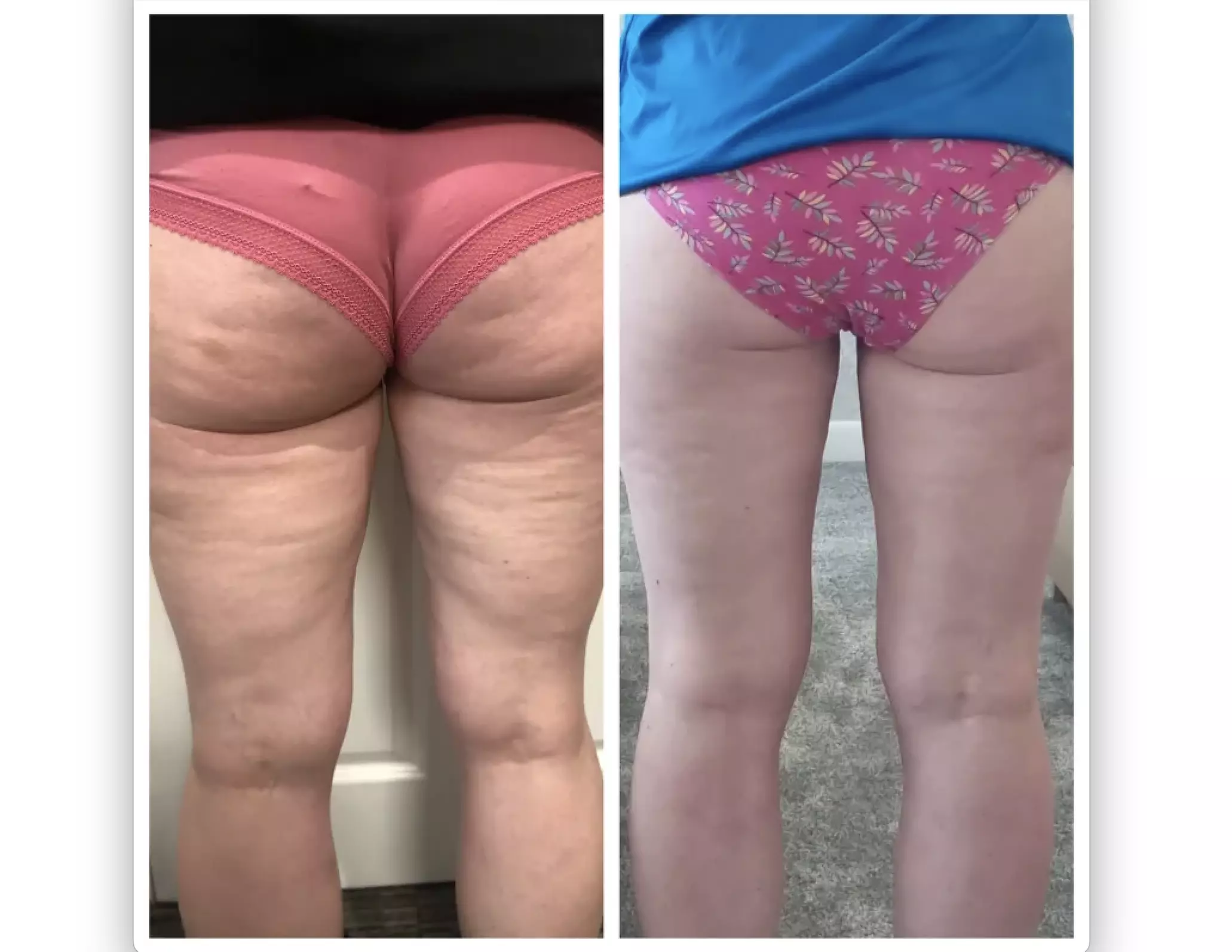 Discover SlimmThicc Aesthetics Spa's HIFU options for face, neck, and body with up to 55% off - Second Medium
