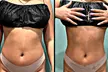 Up to 36% Off on Cavitation at Beauty By Gauthier - Second Medium