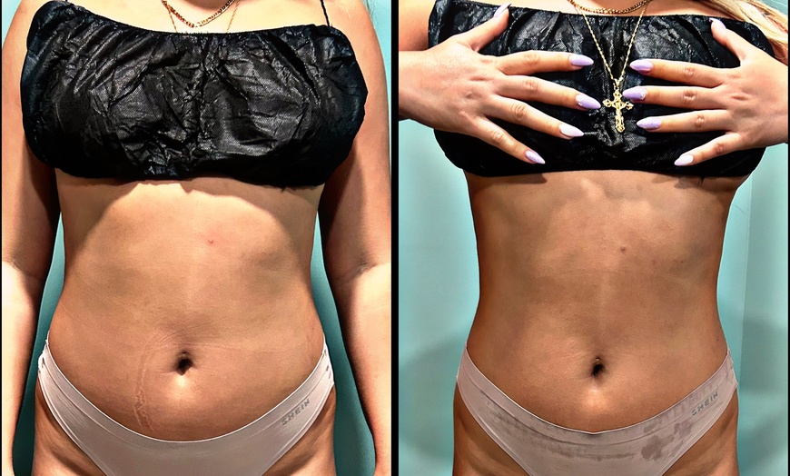 Image 2: Up to 43% Off on Cavitation at Beauty By Gauthier