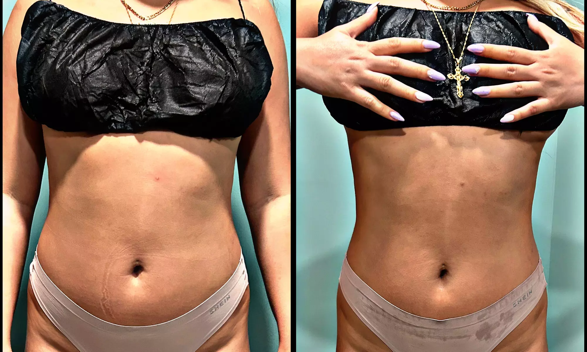 Up to 43% Off on Cavitation at Beauty By Gauthier