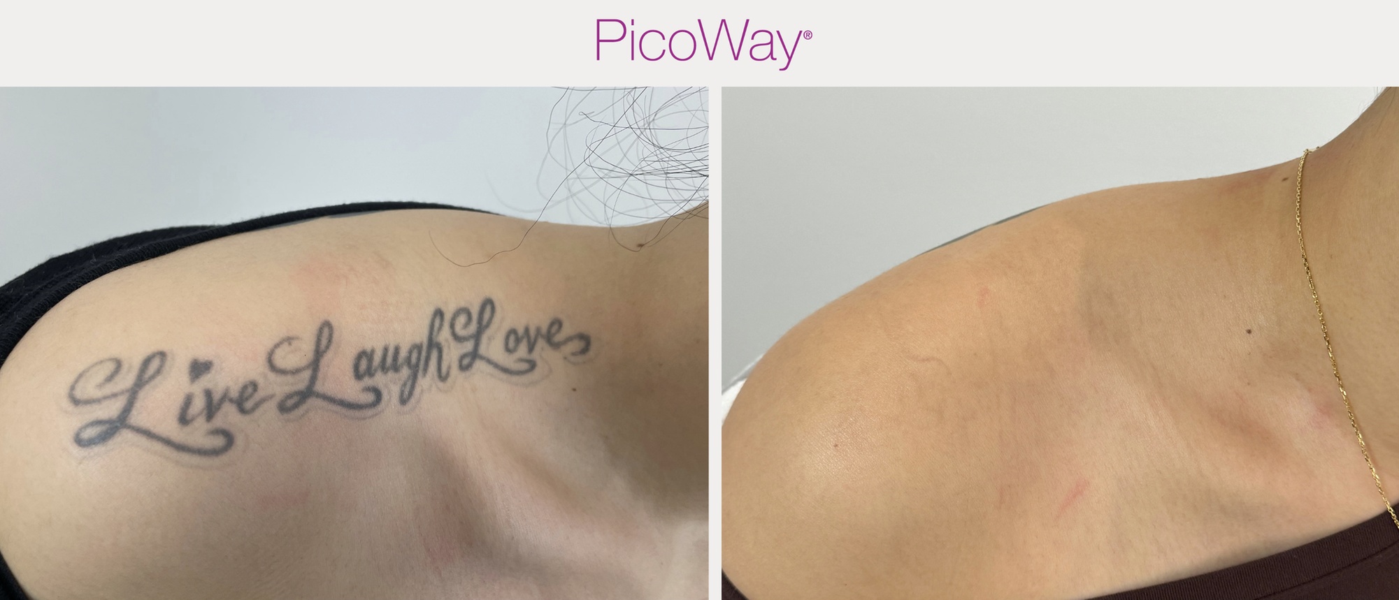 Laser Tattoo & Brow Removal for All Sizes and Skin Types