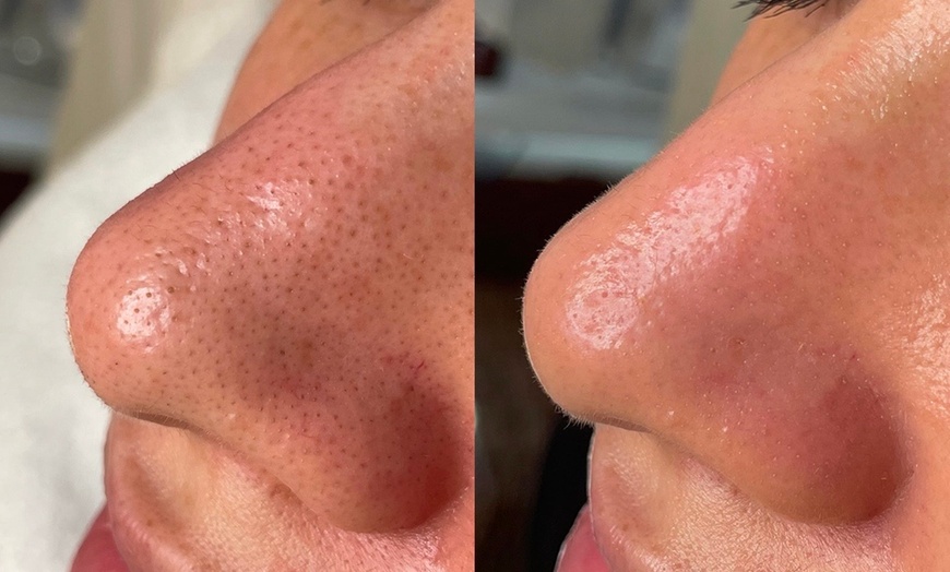 Image 2: Glow Up with 1 or 3 Hydrafacial Sessions with LED Light Therapy