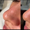 Image 2: Glow Up with 1 or 3 Hydrafacial Sessions with LED Light Therapy