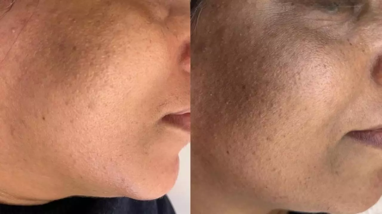 Luxury 1,2 or 3 60-Minute Chemical Peel or Signature Facials